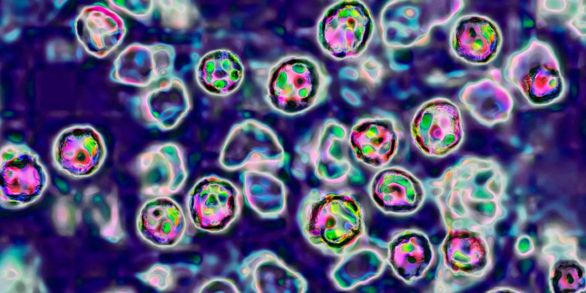 Measles outbreak in Texas balloons to 90 circumstances