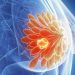 Chemotherapy Linked to Persistent Bodily Well being Decline in Breast Most cancers Survivors