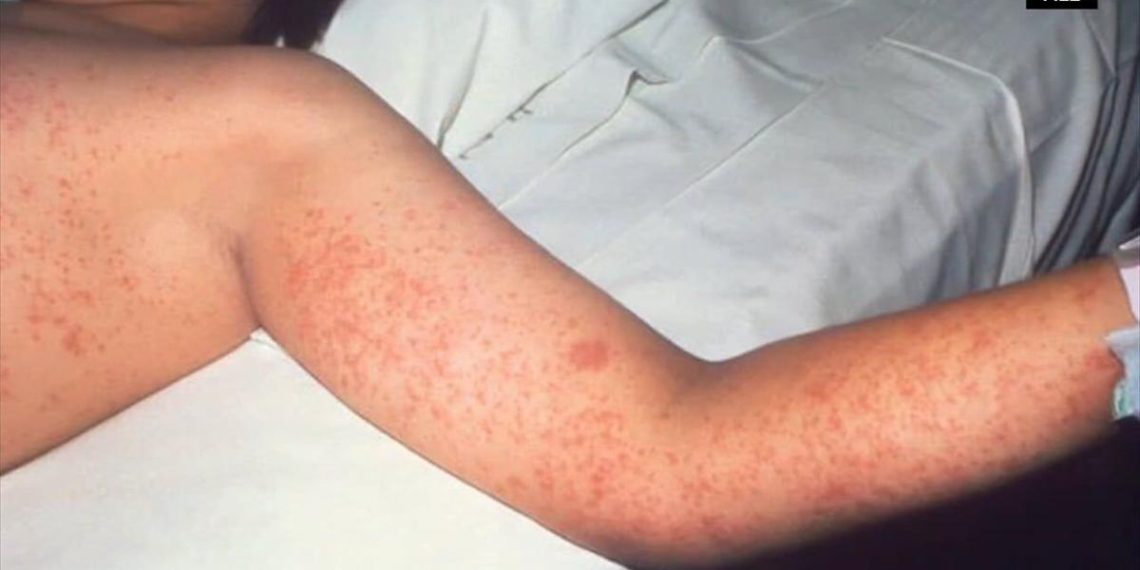 Montgomery County studies measles case linked to worldwide journey | Higher Montgomery County