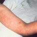 Montgomery County studies measles case linked to worldwide journey | Higher Montgomery County