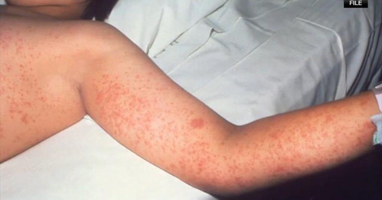 Montgomery County studies measles case linked to worldwide journey | Higher Montgomery County
