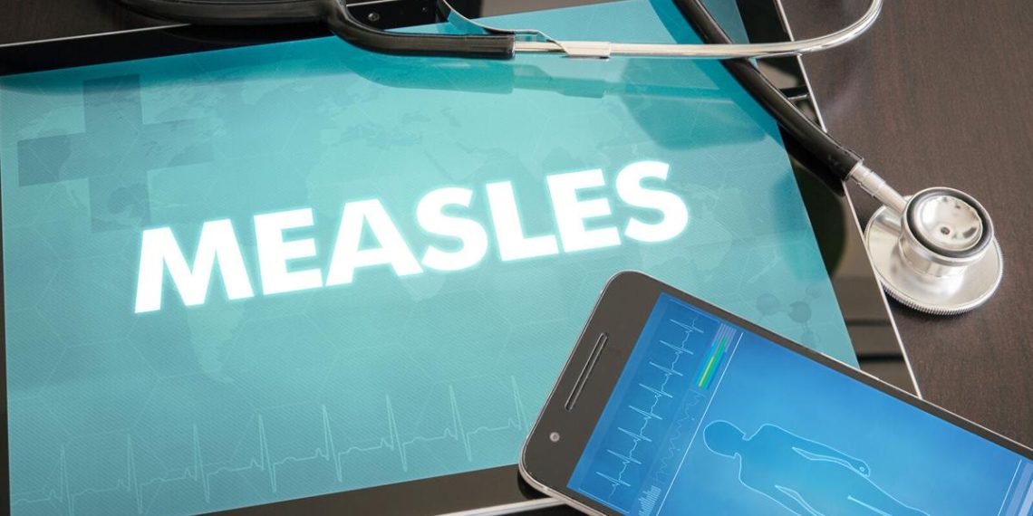 Tuolumne County well being officers examine 2 suspected measles instances | Information