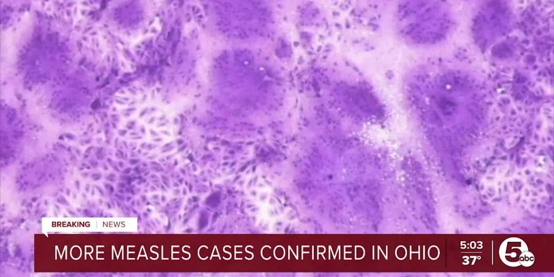 Division of Well being confirms measles outbreak in Ohio – Yahoo
