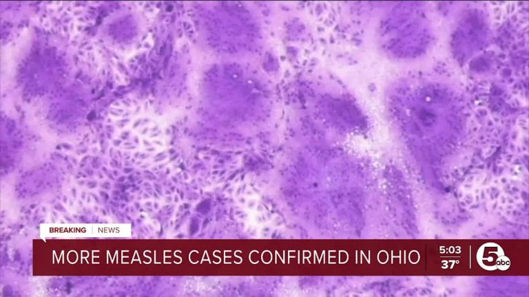 Division of Well being confirms measles outbreak in Ohio – Yahoo