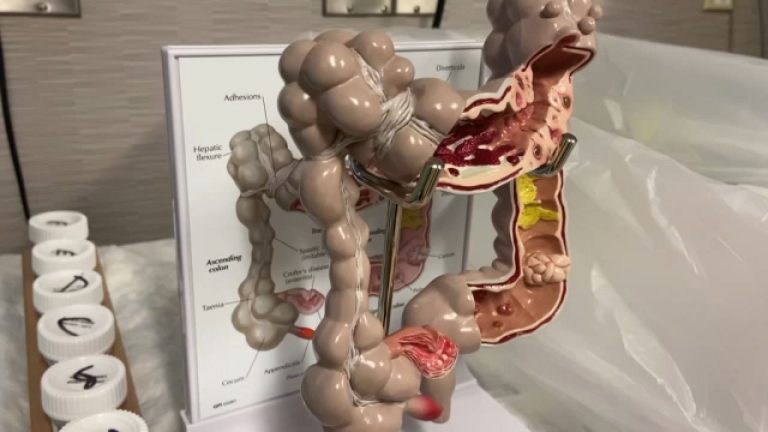 Well being professionals urge colon most cancers screenings