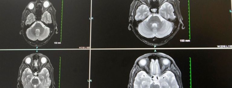 Understanding the connection of coronary heart well being and strokes