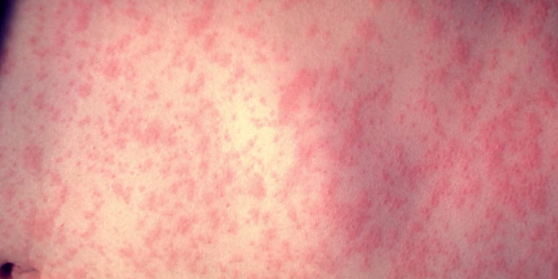 Suffolk County youngster exams constructive for measles, well being officers say