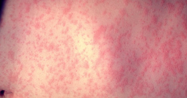 Suffolk County youngster exams constructive for measles, well being officers say