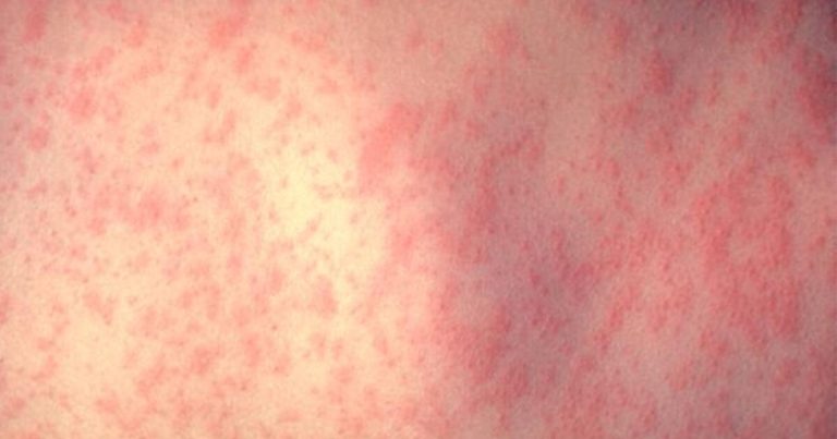 Well being officers intently monitoring a number of measles circumstances throughout the nation