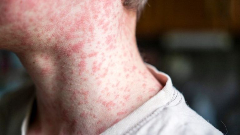 Missoula well being officers gearing up as measles arrives in Montana