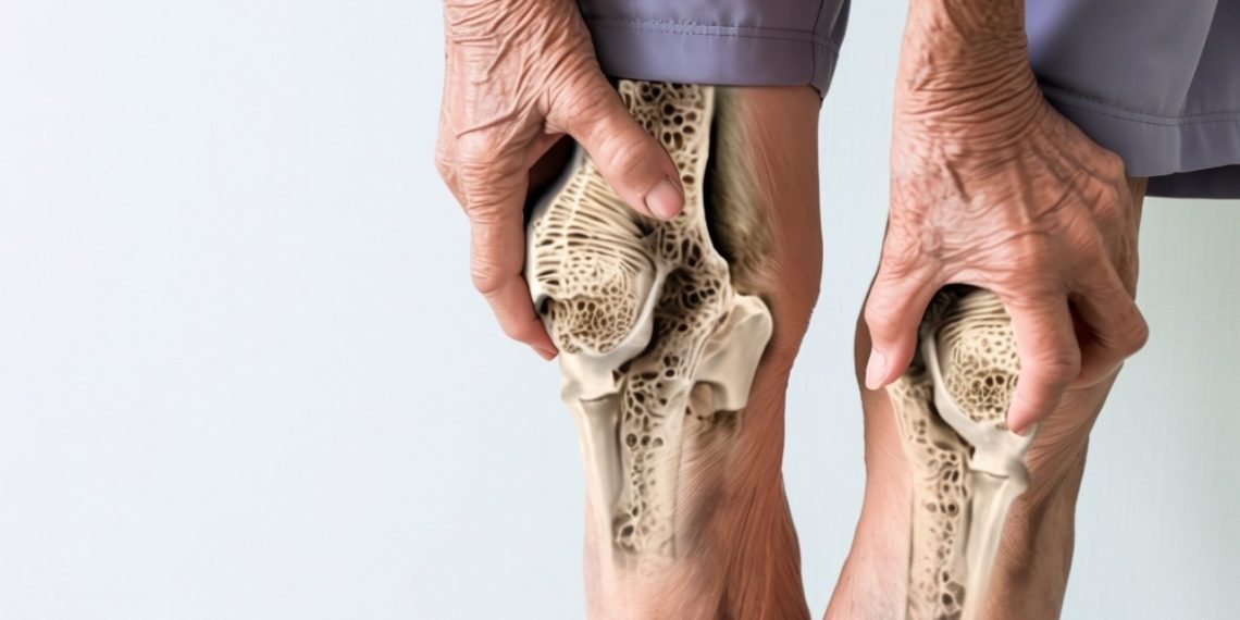 Weight-loss way of life adjustments gradual bone loss in older adults