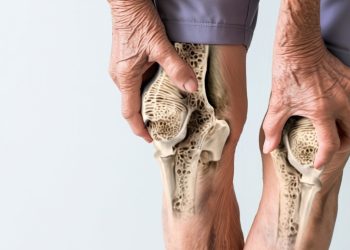 Weight-loss way of life adjustments gradual bone loss in older adults