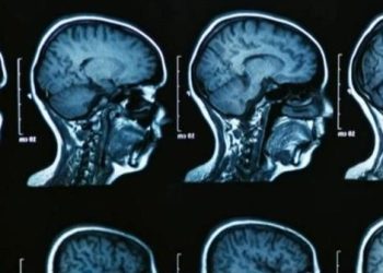 How Trump well being company cuts might impression Alzheimer’s analysis and sufferers