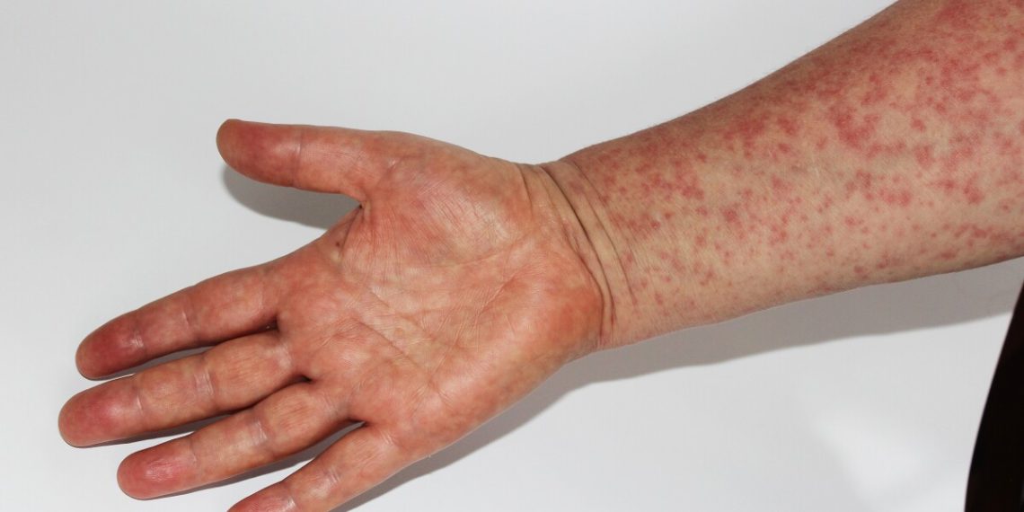 Youngster reported constructive for measles in Collin County