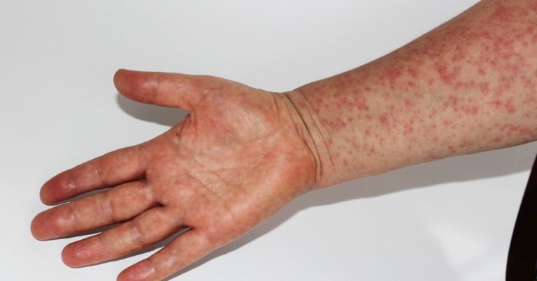 Youngster reported constructive for measles in Collin County