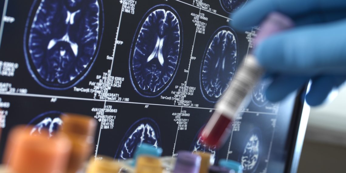 Newest Alzheimer’s lab exams deal with reminiscence loss, not mind plaques : Pictures