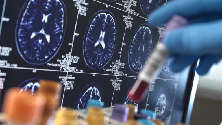 Newest Alzheimer’s lab exams deal with reminiscence loss, not mind plaques : Pictures
