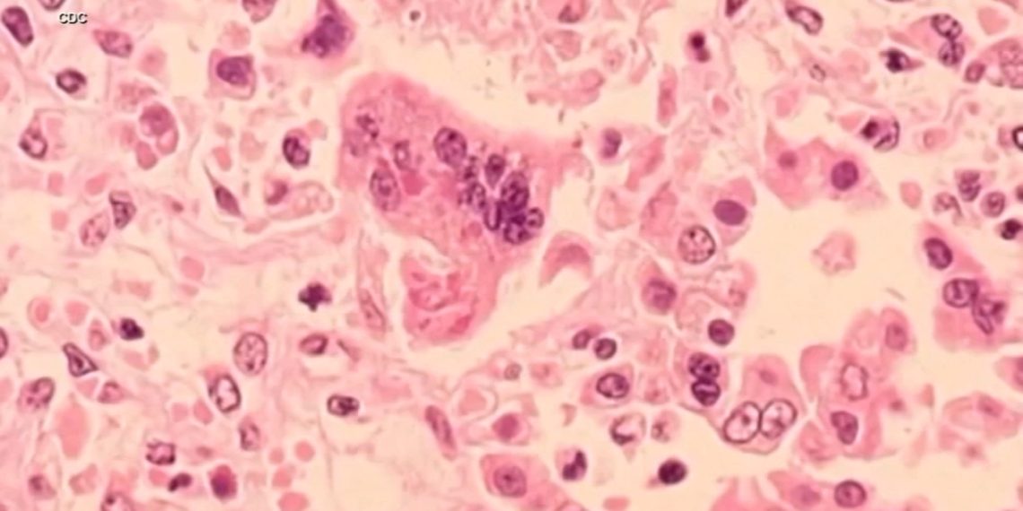 Bay Space well being officers warn of potential measles publicity