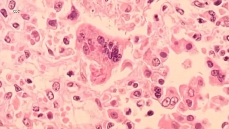 Bay Space well being officers warn of potential measles publicity