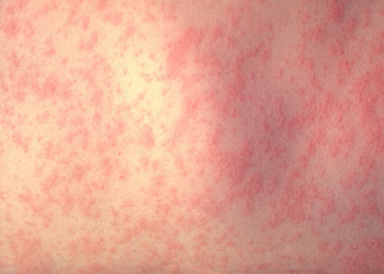 Virginia well being officers verify state’s second case of measles in teen
