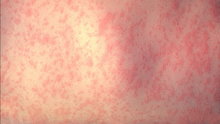 Virginia well being officers verify state’s second case of measles in teen