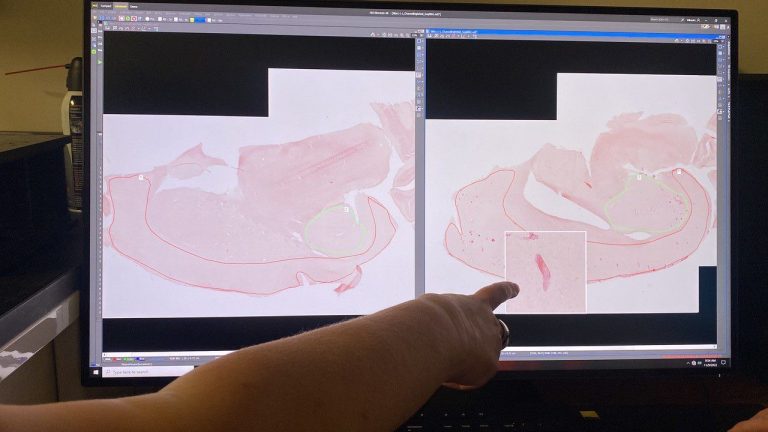 Potential therapy for neurodegenerative situations