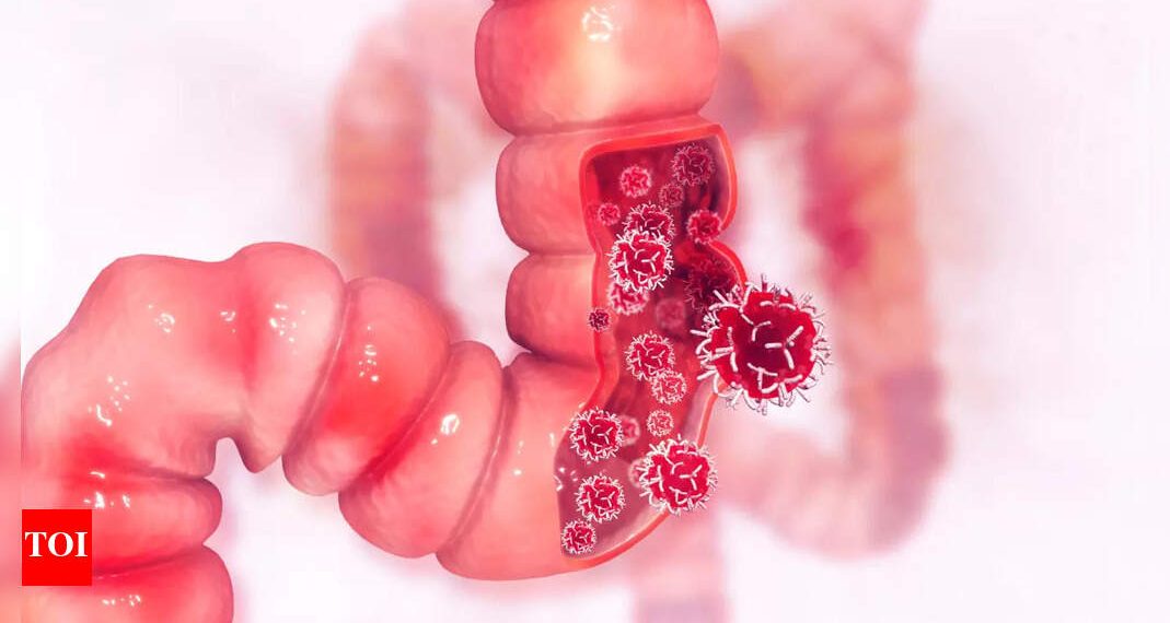 Colon Most cancers: Extra highly effective than capsules? How this widespread observe helped colon most cancers survivors reside longer |