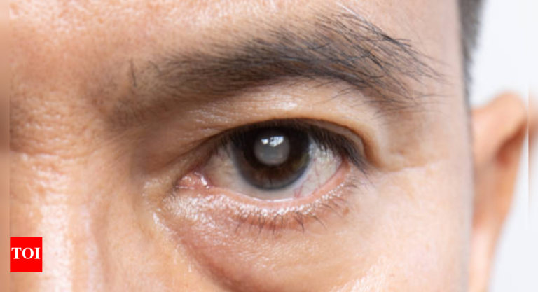 5 frequent myths about cataracts debunked