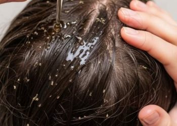 No Extra Lice: 7 Straightforward House Tips That Truly Work – Zee Information