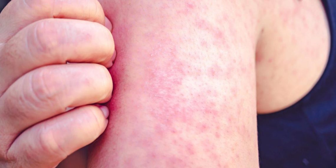 Measles publicity at Billings airport prompts well being alert | Billings Information