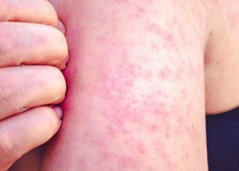 Measles publicity at Billings airport prompts well being alert | Billings Information