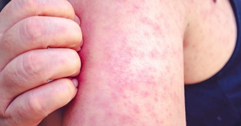 Measles publicity at Billings airport prompts well being alert | Billings Information