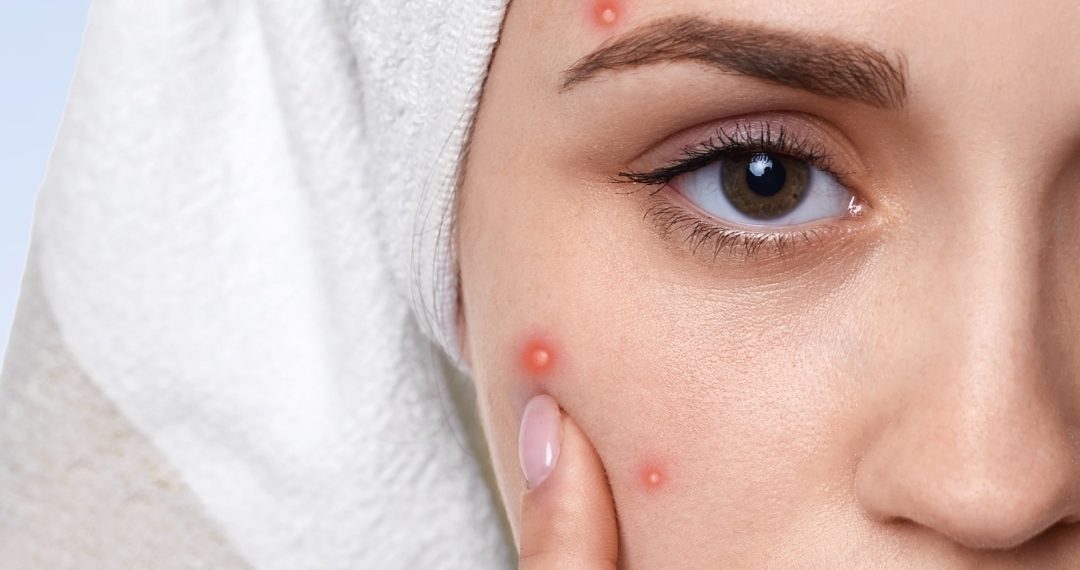 9 Easy Life-style Modifications To Forestall Pimples Naturally – ABP Stay English