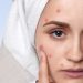 9 Easy Life-style Modifications To Forestall Pimples Naturally – ABP Stay English