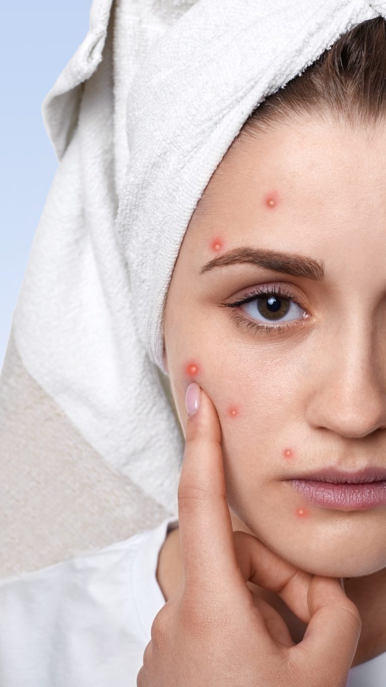 9 Easy Life-style Modifications To Forestall Pimples Naturally – ABP Stay English