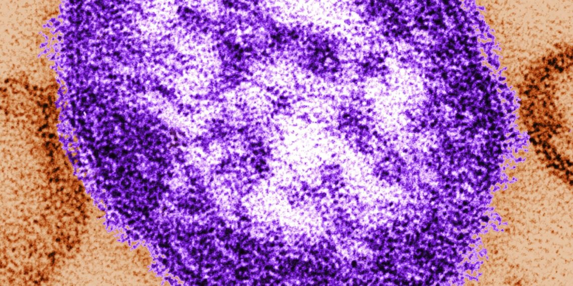 DC well being officers verify case of measles
