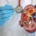 World Kidney Most cancers Day: What Are The Causes, Signs And Prevention? | Way of life Information