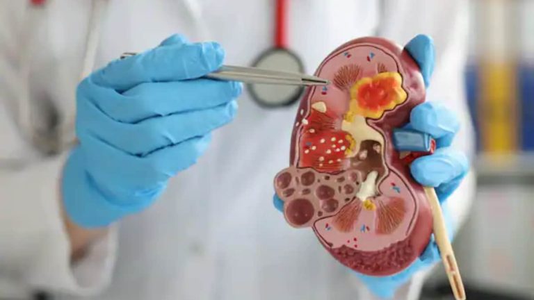 World Kidney Most cancers Day: What Are The Causes, Signs And Prevention? | Way of life Information
