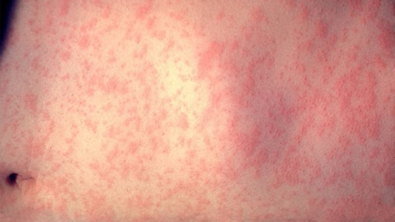 SCVNews.com | Public Well being Confirms Measles Case in SCV